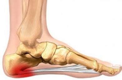 Plantar Fasciitis
